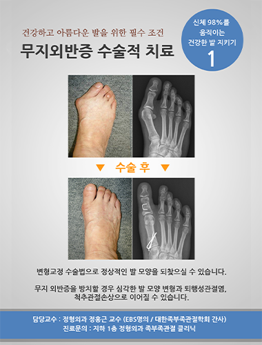 무지외반증 수술적 치료